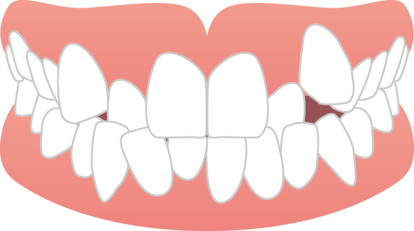 軽度のガタガタ歯並びや八重歯 